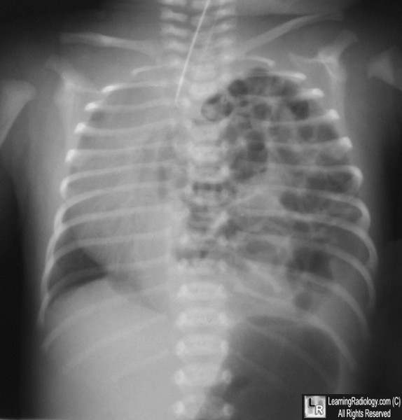 Congenital Absence of the Diaphragm